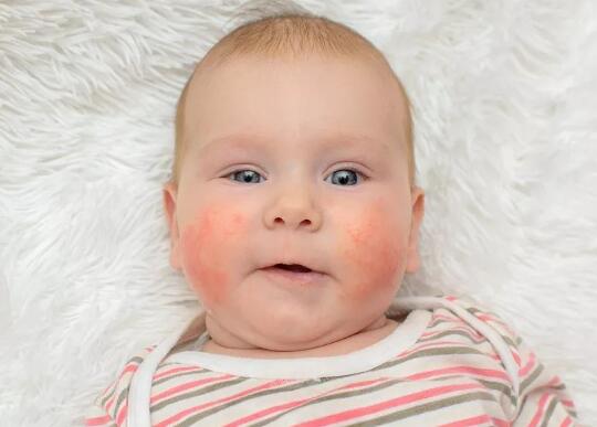 婴儿得了湿疹要少喝水吗？